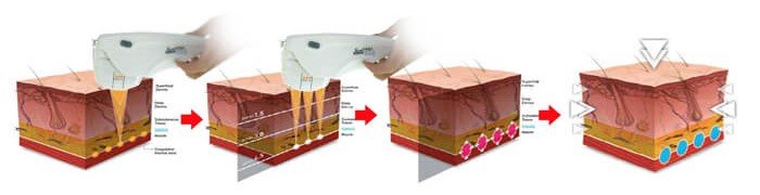 HIFU Anti Aging Treatment in Hyderabad at SkinVive by Dr. Karishni Chittarvu